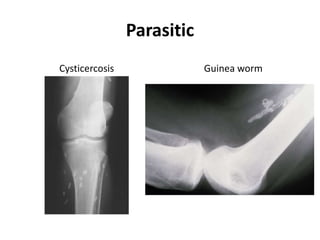 Parasitic 
Cysticercosis Guinea worm 
 