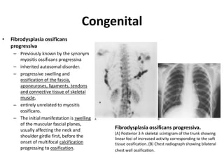 Congenital 
• Fibrodysplasia ossificans 
progressiva 
– Previously known by the synonym 
myositis ossificans progressiva 
– inherited autosomal disorder. 
– progressive swelling and 
ossification of the fascia, 
aponeuroses, ligaments, tendons 
and connective tissue of skeletal 
muscle, 
– entirely unrelated to myositis 
ossificans. 
– The initial manifestation is swelling 
of the muscular fascial planes, 
usually affecting the neck and 
shoulder girdle first, before the 
onset of multifocal calcification 
progressing to ossification. 
Fibrodysplasia ossificans progressiva. 
(A) Posterior 3-h skeletal scintigram of the trunk showing 
linear foci of increased activity corresponding to the soft 
tissue ossification. (B) Chest radiograph showing bilateral 
chest wall ossification. 
 