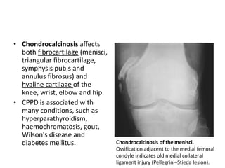 • Chondrocalcinosis affects 
both fibrocartilage (menisci, 
triangular fibrocartilage, 
symphysis pubis and 
annulus fibrosus) and 
hyaline cartilage of the 
knee, wrist, elbow and hip. 
• CPPD is associated with 
many conditions, such as 
hyperparathyroidism, 
haemochromatosis, gout, 
Wilson's disease and 
diabetes mellitus. Chondrocalcinosis of the menisci. 
Ossification adjacent to the medial femoral 
condyle indicates old medial collateral 
ligament injury (Pellegrini–Stieda lesion). 
 