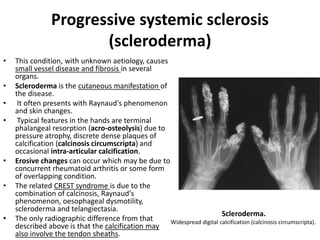 Progressive systemic sclerosis 
(scleroderma) 
• This condition, with unknown aetiology, causes 
small vessel disease and fibrosis in several 
organs. 
• Scleroderma is the cutaneous manifestation of 
the disease. 
• It often presents with Raynaud's phenomenon 
and skin changes. 
• Typical features in the hands are terminal 
phalangeal resorption (acro-osteolysis) due to 
pressure atrophy, discrete dense plaques of 
calcification (calcinosis circumscripta) and 
occasional intra-articular calcification. 
• Erosive changes can occur which may be due to 
concurrent rheumatoid arthritis or some form 
of overlapping condition. 
• The related CREST syndrome is due to the 
combination of calcinosis, Raynaud's 
phenomenon, oesophageal dysmotility, 
scleroderma and telangiectasia. 
• The only radiographic difference from that 
described above is that the calcification may 
also involve the tendon sheaths. 
Scleroderma. 
Widespread digital calcification (calcinosis circumscripta). 
 