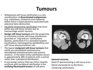 Tumours 
• Widespread soft tissue calcification is a rare 
manifestation of disseminated malignancies 
(e.g. metastases, leukaemia and myeloma) 
where there is hypercalcaemia associated with 
extensive bone destruction. 
• Localized intratumoral calcification may occur 
within any soft tissue tumour due to 
haemorrhage and/or necrosis. 
• Benign soft tissue tumours with the propensity 
to mineralize include soft tissue chondromas 
(punctate or ‘ring-and-arc’ calcification), 
lipomas, particularly if in a parosteal location 
(ossification), haemangiomas (phleboliths) and 
soft tissue aneurysmal bone cyst. 
• The typical malignant soft tissue tumours that 
calcify are extraskeletal osteosarcoma, 
extraskeletal chondrosarcoma and synovial 
sarcoma . In the latter entity calcification occurs 
in approximately 30% of patients with a central 
rather than a peripheral distribution. 
• A rare benign tumour that can mimic myositis 
ossificans with peripheral calcification is the 
ossifying fibromyxoid tumour of soft parts. 
Synovial sarcoma. 
Axial CT demonstrating a soft tissue mass 
lateral and posterior to the femur 
containing calcifications. 
 