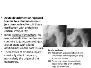 • Acute detachment or repeated 
trauma to a tendino-osseous 
junction can lead to soft tissue 
ossification with underlying 
cortical irregularity. 
• In the skeletally immature, an 
avulsed ossification centre may 
continue to grow, presenting at 
a later stage with a large 
ossified mass in the soft tissues. 
• These types of avulsion injury 
classically affect the pelvis, 
particularly the origin of the 
hamstrings. 
Ischial avulsion. 
(A) Radiograph at presentation shows 
the avulsed ischial apophysis lying 
in the soft tissues. 
(B) Three years later the apophysis 
has continued to grow to form a 
large ossified mass 
 