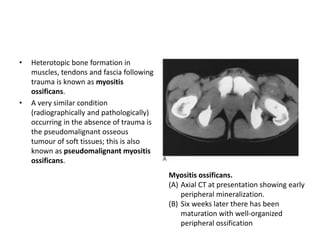 • Heterotopic bone formation in 
muscles, tendons and fascia following 
trauma is known as myositis 
ossificans. 
• A very similar condition 
(radiographically and pathologically) 
occurring in the absence of trauma is 
the pseudomalignant osseous 
tumour of soft tissues; this is also 
known as pseudomalignant myositis 
ossificans. 
Myositis ossificans. 
(A) Axial CT at presentation showing early 
peripheral mineralization. 
(B) Six weeks later there has been 
maturation with well-organized 
peripheral ossification 
 