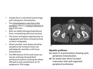 • Initially there is interstitial haemorrhage 
with subsequent mineralization. 
• The mineralization is seen first in the 
periphery; there is a gradual reduction in 
size of the mass . 
• Both are helpful distinguishing features 
from a mineralizing soft tissue sarcoma. 
• The lesions will appear hypervascular on 
angiography and show increased activity 
on bone scintigraphy. 
• Where possible, early biopsy should be 
avoided as the immature lesion can 
pathologically resemble a soft tissue 
osteosarcoma. 
• The MRI features of the early lesion can 
also be confusing showing florid 
perilesional oedema involving the whole 
affected muscle compartment on T2- 
weighted or STIR images 
Myositis ossificans. 
(A) Axial CT at presentation showing early 
peripheral mineralization. 
(B) Six weeks later there has been 
maturation with well-organized 
peripheral ossification 
 
