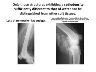 Only those structures exhibiting a radiodensity 
sufficiently different to that of water can be 
distinguished from other soft tissues. 
Less than muscle - fat and gas 
Increased radiodensity - haemosiderin deposition, 
mineralization, be it calcification or ossification, and 
certain foreign bodies 
 