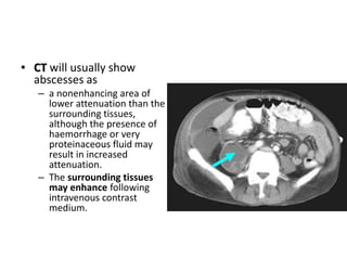 • CT will usually show 
abscesses as 
– a nonenhancing area of 
lower attenuation than the 
surrounding tissues, 
although the presence of 
haemorrhage or very 
proteinaceous fluid may 
result in increased 
attenuation. 
– The surrounding tissues 
may enhance following 
intravenous contrast 
medium. 
 
