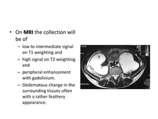 • On MRI the collection will 
be of 
– low to intermediate signal 
on T1 weighting and 
– high signal on T2 weighting 
and 
– peripheral enhancement 
with gadolinium. 
– Oedematous change in the 
surrounding tissues often 
with a rather feathery 
appearance. 
 