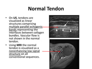 Normal Tendon 
• On US, tendons are 
visualized as linear 
structures comprising 
multiple parallel echogenic 
bands representing the 
interfaces between collagen 
bundles. Vascular flow is 
not shown in the normal 
tendon. 
• Using MRI the normal 
tendon is visualized as a 
nonenhancing low signal 
structure on all 
conventional sequences. 
 
