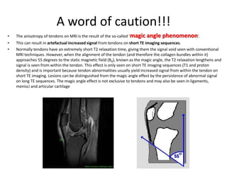 A word of caution!!! 
• The anisotropy of tendons on MRI is the result of the so-called ‘magic angle phenomenon’. 
• This can result in artefactual increased signal from tendons on short TE imaging sequences. 
• Normally tendons have an extremely short T2 relaxation time, giving them the signal void seen with conventional 
MRI techniques. However, when the alignment of the tendon (and therefore the collagen bundles within it) 
approaches 55 degrees to the static magnetic field (B0), known as the magic angle, the T2 relaxation lengthens and 
signal is seen from within the tendon. This effect is only seen on short TE imaging sequences (T1 and proton 
density) and is important because tendon abnormalities usually yield increased signal from within the tendon on 
short TE imaging. Lesions can be distinguished from the magic angle effect by the persistence of abnormal signal 
on long TE sequences. The magic angle effect is not exclusive to tendons and may also be seen in ligaments, 
menisci and articular cartilage 
 