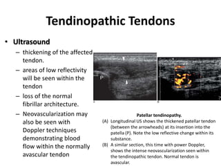 Tendinopathic Tendons 
• Ultrasound 
– thickening of the affected 
tendon. 
– areas of low reflectivity 
will be seen within the 
tendon 
– loss of the normal 
fibrillar architecture. 
– Neovascularization may 
also be seen with 
Doppler techniques 
demonstrating blood 
flow within the normally 
avascular tendon 
Patellar tendinopathy. 
(A) Longitudinal US shows the thickened patellar tendon 
(between the arrowheads) at its insertion into the 
patella (P). Note the low reflective change within its 
substance. 
(B) A similar section, this time with power Doppler, 
shows the intense neovascularization seen within 
the tendinopathic tendon. Normal tendon is 
avascular. 
 