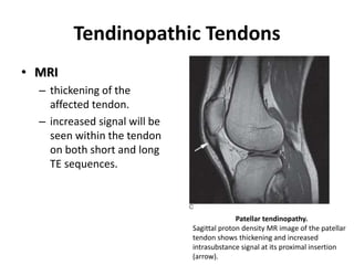 Tendinopathic Tendons 
• MRI 
– thickening of the 
affected tendon. 
– increased signal will be 
seen within the tendon 
on both short and long 
TE sequences. 
Patellar tendinopathy. 
Sagittal proton density MR image of the patellar 
tendon shows thickening and increased 
intrasubstance signal at its proximal insertion 
(arrow). 
 