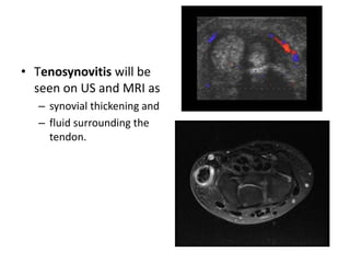 • Tenosynovitis will be 
seen on US and MRI as 
– synovial thickening and 
– fluid surrounding the 
tendon. 
 