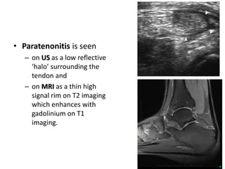 • Paratenonitis is seen 
– on US as a low reflective 
‘halo’ surrounding the 
tendon and 
– on MRI as a thin high 
signal rim on T2 imaging 
which enhances with 
gadolinium on T1 
imaging. 
 