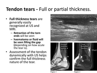 Tendon tears - Full or partial thickness. 
• Full thickness tears are 
generally easily 
recognized at US and 
MRI. 
– Retraction of the torn 
ends will be seen 
– haematoma or fluid will 
be seen filling the gap 
(depending on how acute 
the tear is). 
• Assessment of the tendon 
dynamically with US helps 
confirm the full thickness 
nature of the tear. 
 