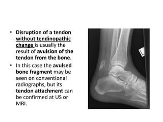 • Disruption of a tendon 
without tendinopathic 
change is usually the 
result of avulsion of the 
tendon from the bone. 
• In this case the avulsed 
bone fragment may be 
seen on conventional 
radiographs, but its 
tendon attachment can 
be confirmed at US or 
MRI. 
 