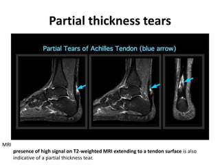 Partial thickness tears 
MRI 
presence of high signal on T2-weighted MRI extending to a tendon surface is also 
indicative of a partial thickness tear. 
 