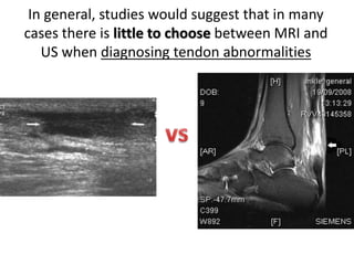 In general, studies would suggest that in many 
cases there is little to choose between MRI and 
US when diagnosing tendon abnormalities 
 