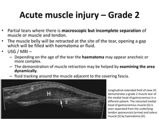 Acute muscle injury – Grade 2 
• Partial tears where there is macroscopic but incomplete separation of 
muscle or muscle and tendon. 
• The muscle belly will be retracted at the site of the tear, opening a gap 
which will be filled with haematoma or fluid. 
• USG / MRI – 
– Depending on the age of the tear the haematoma may appear anechoic or 
more complex. 
– The demonstration of muscle retraction may be helped by examining the area 
dynamically. 
– fluid tracking around the muscle adjacent to the covering fascia. 
Longitudinal extended field of view US 
demonstrates a grade 2 muscle tear of 
the medial head of gastrocnemius in a 
different patient. The retracted medial 
head of gastrocnemius muscle (G) is 
seen separated from the underlying 
tendon aponeurosis (arrow) and soleus 
muscle (S) by haematoma (H). 
 