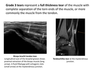 Grade 3 tears represent a full thickness tear of the muscle with 
complete separation of the torn ends of the muscle, or more 
commonly the muscle from the tendon. 
Biceps brachii tendon tear. 
Longitudinal scan of the bicipital groove shows 
proximal retraction of the biceps muscle (long 
arrow). A fluid-filled gap with echogenic clots 
(small arrow) at the myotendinous junction. 
Tendoachilles tear at the myotendinous 
junction. 
 