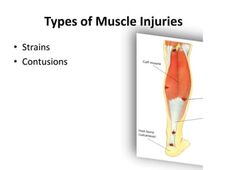 Types of Muscle Injuries
• Strains
• Contusions
 
