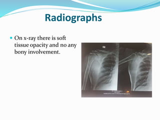 Radiographs
 On x-ray there is soft
tissue opacity and no any
bony involvement.
 