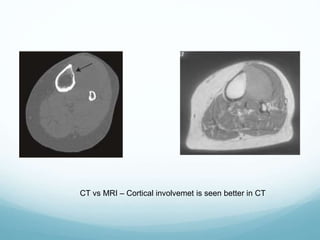CT vs MRI – Cortical involvemet is seen better in CT
 