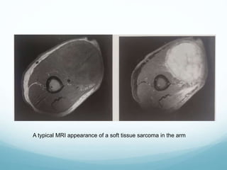 A typical MRI appearance of a soft tissue sarcoma in the arm
 