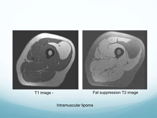 Intramuscular lipoma
T1 image - Fat suppression T2 image
 