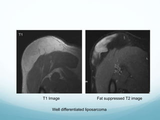 Well differentiated liposarcoma
T1 Image Fat suppressed T2 image
 