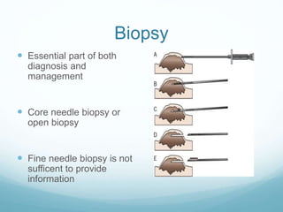 Biopsy
 Essential part of both
diagnosis and
management
 Core needle biopsy or
open biopsy
 Fine needle biopsy is not
sufficent to provide
information
 