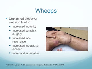 Whoops
 Unplanned biopsy or
excision lead to
 Increased mortality
 Increased complex
surgery
 Increased local
recurrence
 Increased metastatic
disease
 Increased amputation
Vodanovich DA, Choong PF. Soft-tissue sarcomas. Indian journal of orthopaedics. 2018 Feb;52:35-44.
 