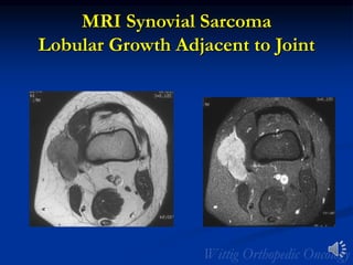 MRI Synovial Sarcoma
Lobular Growth Adjacent to Joint
 
