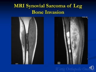 MRI Synovial Sarcoma of Leg
Bone Invasion
 