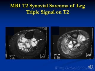 MRI T2 Synovial Sarcoma of Leg
Triple Signal on T2
 