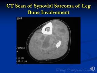 CT Scan of Synovial Sarcoma of Leg
Bone Involvement
 