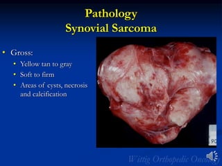 Pathology
Synovial Sarcoma
• Gross:
• Yellow tan to gray
• Soft to firm
• Areas of cysts, necrosis
and calcification
 
