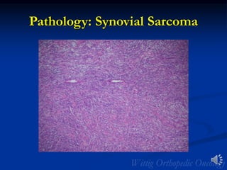 Pathology: Synovial Sarcoma
 