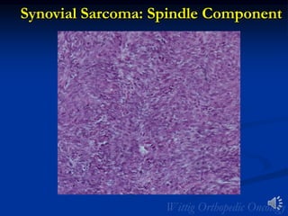 Synovial Sarcoma: Spindle Component
 
