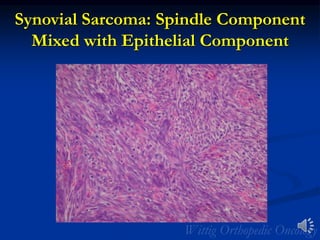 Synovial Sarcoma: Spindle Component
Mixed with Epithelial Component
 