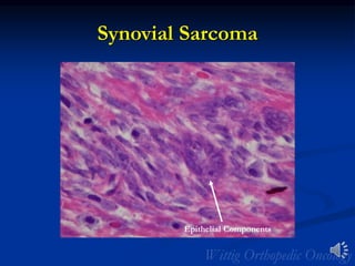 Synovial Sarcoma
Epithelial Components
 