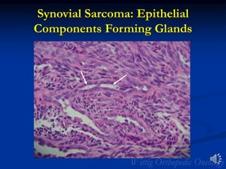 Synovial Sarcoma: Epithelial
Components Forming Glands
 