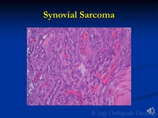 Synovial Sarcoma
 