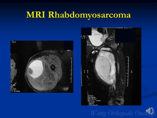 MRI Rhabdomyosarcoma
 