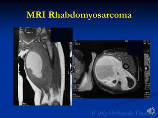 MRI Rhabdomyosarcoma
 