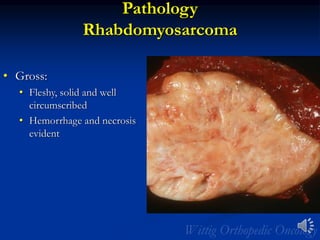 Pathology
Rhabdomyosarcoma
• Gross:
• Fleshy, solid and well
circumscribed
• Hemorrhage and necrosis
evident
 