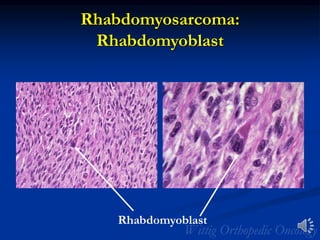 Rhabdomyosarcoma:
Rhabdomyoblast
Rhabdomyoblast
 
