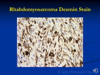 Rhabdomyosarcoma Desmin Stain
 