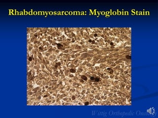 Rhabdomyosarcoma: Myoglobin Stain
 