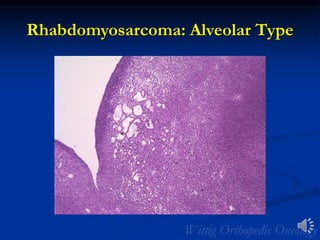 Rhabdomyosarcoma: Alveolar Type
 