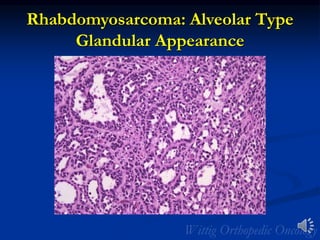 Rhabdomyosarcoma: Alveolar Type
Glandular Appearance
 